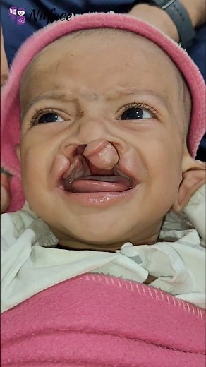 Wide Bilateral Cleft Lip Repair | Before - After | Dr Parit Ladani