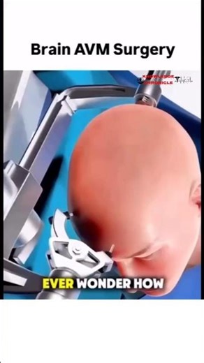 Brain AVM Surgery: Advanced Treatment Procedure, Surgical Techniques, and Patient Recovery #shorts