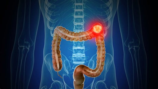 'Subtle' signs of colorectal cancer as it becomes biggest killer of under 50s