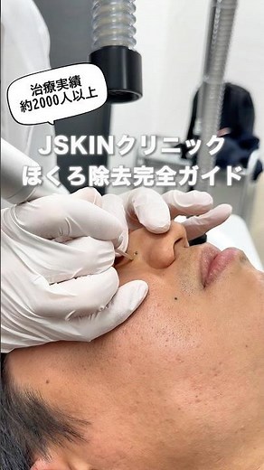 ほくろ施術完全版ガイド💡詳しくは【ほくろ取り放題 jskin】で検索🔍 #美容 #ほくろ #ほくろ除去 #レーザー #美容皮膚科