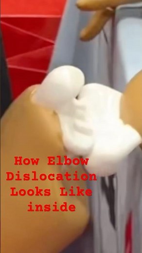 DISLOCATED JOINTS : How to Pop back in! #orthopedic #sportsmedicine