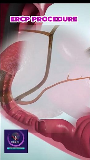 ERCP Procedure: for Bile Duct Obstruction Removal