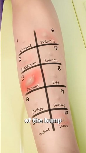 How A Skin Prick Test Works 🤔 Surgeon Reacts