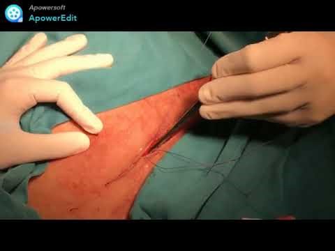 Comment je fais un surjet intradermique en fin de césarienne