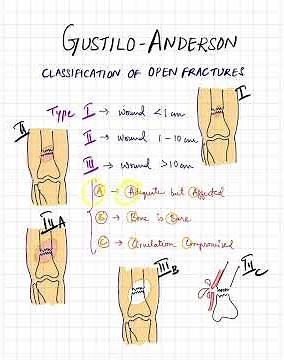 Mnemonics for Gustilo-Anderson classification of open fractures!! #neetpg #pyq #inicet #mbbs #usmle