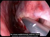Inferior Turbinate Submucous Resection (SMR) • Video • MEDtube.net