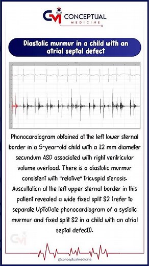 🫀 Diastolic Murmur in Atrial Septal Defect (ASD)