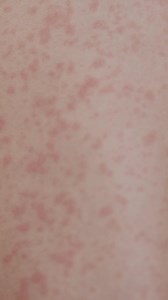 Were you born between 1966 and 1994? You may not be fully protected against measles. If you’re unsure, ask your GP. Free vaccines are available. | SA Health