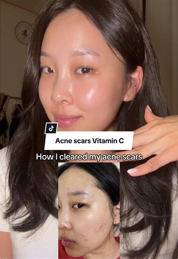 Clear Acne Scars Effectively with Rovectin Serum