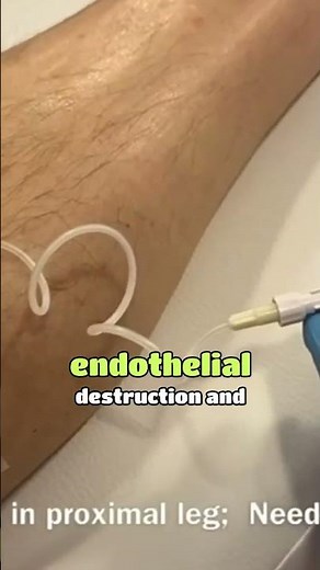 Have you injected enough foam? A Simple Test for Foam Sclerotherapy Success; The Spasm Test