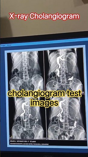 Cholangiogram Test | Bile Duct Imaging#medical #doctor #radiographer