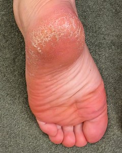 41K views · 253 reactions | Say goodbye to dry, cracked feet with these nourishing foot treatments✨ | MetDaan | Facebook