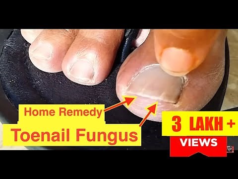Home Remedy Cure for Toenail Fungus | The Best Nail Fungus Treatment Cure with Vicks VapoRub