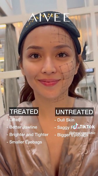 Discover Aivee Thermage FLX for Non-Invasive Skin Tightening
