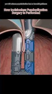 How Incisionless Fundoplication Surgery Is Performed (3D Animation)#endoscopicsurgery #acidreflux