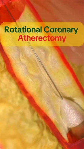 ECG | Coronary Rotational Atherectomy — Quick Summary ✅ A procedure using a rotating diamond-tipped burr to remove calcified plaque in coronary... | Instagram
