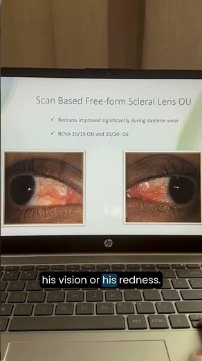 Custom Scleral Lens Success!