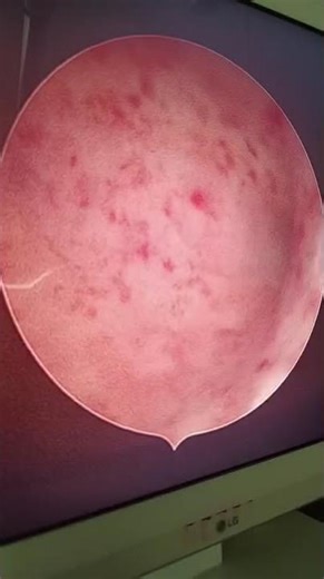 Diagnostic Hysteroscopy with positive Tubal patency test..& thin endometrium.