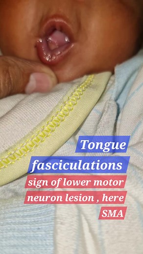 6.1K views · 145 reactions | Tongue fasciculations- SMA | Dr. Arshad Mehmood - Child Specialist | Facebook