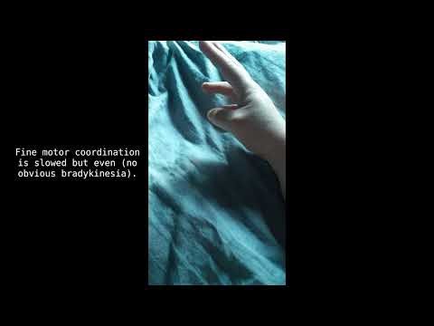 Pathological Inertia/Psychomotor Retardation (video 1 of 2)