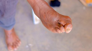 Warbixin:- Gabiley Wiiil Jidhkiisa loo jar jaray xanuunka Macaanka. | Ayaanle Xaaji Mohamed