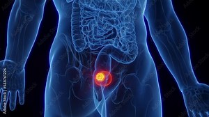 3d rendered medical animation of urinary bladder cancer in a man