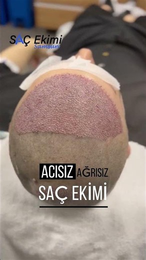 En İyi Saç Ekimi Merkezi Nasıl Seçilir? Samsun #shorts
