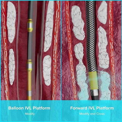 Shockwave Balloon IVL Platform vs Shockwave Forward IVL Platform