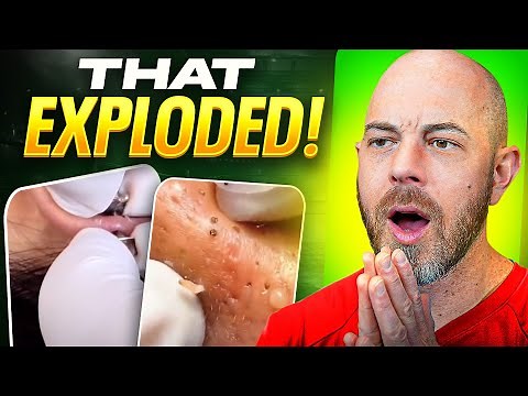 Dermatologist Reviews TikTok’s Most Viral Pimple Pops