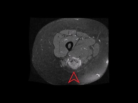 Thigh MRI: Full Thickness Hamstring Tear, Ischial Tuberosity Avulsion Fracture