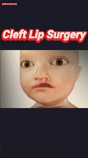 Cleft Lip Repair Step By Step #animation #surgical