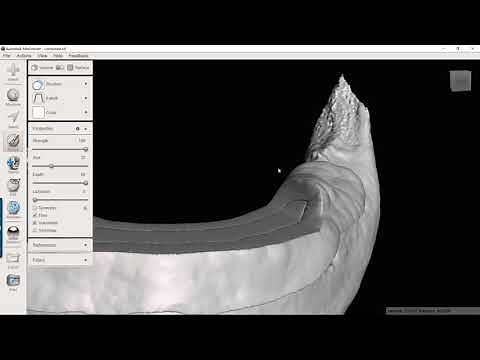 Creating a Bone Reduction Guide and Surgical Guide with Blue Sky Plan