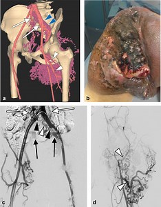 Multimodal Treatment for a Giant Unresectable Peripheral Arteriovenous Malformation