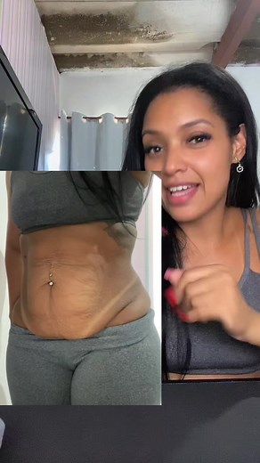Abdominoplastia SUS: Minha Jornada Pós-Parto e Emagrecimento