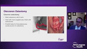 Intra-Articular Distal Humerus Fractures: Tips and Tricks
