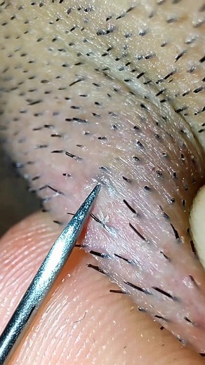 #ingrownhair #beard #extraction #tweezers #pimple