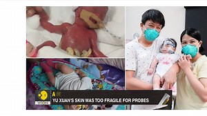 #Gravitas | The world's tiniest baby weighed less than a large apple on birth. Her name is Kwek Yu Xuan, and she was delivered in just 25 weeks. Yu Xuan fought against all odds and went home after spending 13 months in hospital. Palki S Upadhyay brings you a story of miracle. | WION