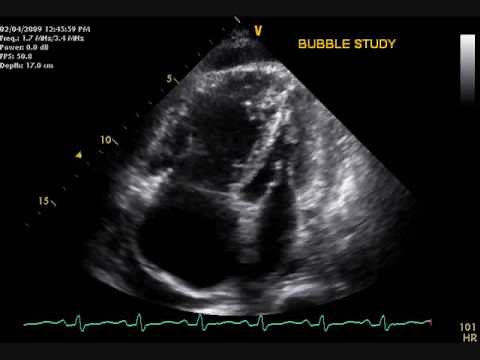 Pulmonary Hypertension echo