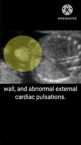 Ectopia cordis on ultrasound #ultrasound #pregnancyscan #pregnant #baby #radiology