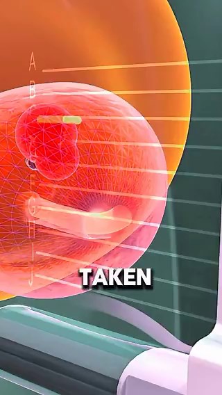 A prostate biopsy is a procedure to remove samples of suspicious tissue from the prostate. The prostate is a small, walnut-shaped gland in males.