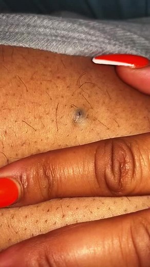 Satisfying Blackhead and Whitehead Squeeze Compilation