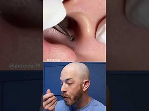 Super satisfying pimple compilation! #pimplepop #dermreacts #doctorreacts