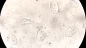 Schistosoma spp. Parasitenei in menschlicher Urinprobe unter dem...