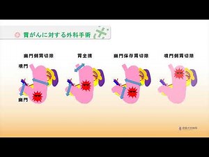 徳島大学病院「TVいきいきらいふ」第158回胃がんに対するロボット手術