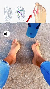 Separar el hallux (primer dedo) del resto durante 5 min diarios ayuda a liberar la articulación metatarsofalángica, disminuye la tensión del aductor del hallux y reactiva músculos estabilizadores como el abductor. Esto evita que el juanete (hallux valgus) progrese y mantiene la función del pie.#juanetes #bunions #dolordepies #fascitisplantar #metatarsalgia | Pablo.pilatesreal