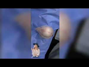 How to pop a giant boil on back, pimple & cyst popping this week, blackheads, zits and acne treatmen