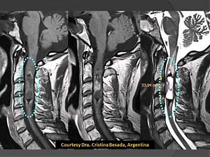 Spinal Masses - Location Intramedullary: Ependymoma