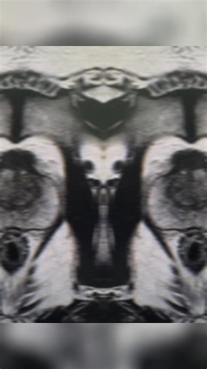 MPP (Multi parametric prostate) Philips MR5300 1.5T blusealed free helium MRI system Mihrbani surgical hospital Iraq / Erbil Showing highly restricted lesions Awara Ibrahem Ragaz Abdulla Mihrabani Surgical Hospital نەخۆشخانەی نەشتەرگەری میهرەبانی | Al-Bahja Trading Company