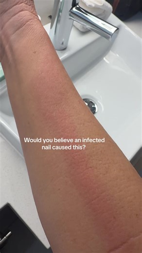 First my thumb hurt really bad, then my wrist.. when my forearm started hurting I knew something was wrong. #nailtok #nail #infection #signofaffection #infectednail