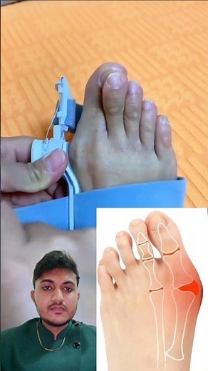 Hallux valgus #bunions #bunioncorrector #halluxvalgus